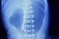 down-pancreas-anular-obstruccion-duodenal-signo-doble-burbuja-postop-sonda-duodenostomia-fototerapia-criolla-001