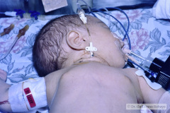 ductus-arterioso-postop-cateter-arterial-axilar-venoso-yugular-tubo-torax-tubo-orotraqueal-sog-001