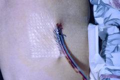 ductus-arterioso-postop-cateter-arterial-axilar-venoso-yugular-tubo-torax-tubo-orotraqueal-sog-002