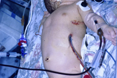 ductus-arterioso-postop-cateter-arterial-axilar-venoso-yugular-tubo-torax-tubo-orotraqueal-sog-003