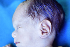 duendecillo-williams-1m-12d-artritis-septica-postop-1986-000