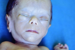duendecillo-williams-1m-12d-artritis-septica-postop-1986-002