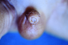 duendecillo-williams-1m-12d-artritis-septica-postop-1986-004