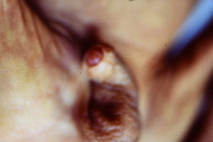 duendecillo-williams-1m-12d-artritis-septica-postop-1986-006