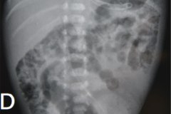 ecn-ib-bell-kliegman-walsh-enterocolitis-necrotizante-o-necrosante-por-cardiopatia-2003-001