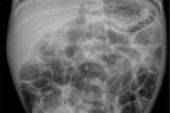 ecn-iia-bell-kliegman-walsh-enterocolitis-necrotizante-o-necrosante-15d-2007-000