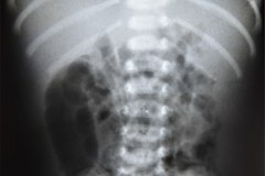 ecn-iia-bell-kliegman-walsh-enterocolitis-necrotizante-o-necrosante-asa-fija-neumatosis-1999-002