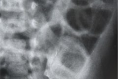 ecn-iia-bell-kliegman-walsh-enterocolitis-necrotizante-o-necrosante-distension-abd-neumatosis-2000-000