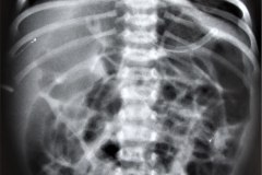 ecn-iia-bell-kliegman-walsh-enterocolitis-necrotizante-o-necrosante-distension-abd-neumatosis-2000-001