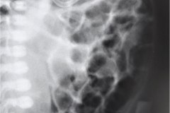 ecn-iia-bell-kliegman-walsh-enterocolitis-necrotizante-o-necrosante-distension-abd-neumatosis-2000-002
