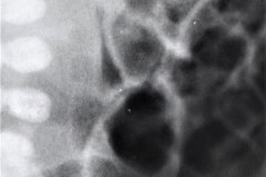 ecn-iia-bell-kliegman-walsh-enterocolitis-necrotizante-o-necrosante-distension-abd-neumatosis-2000-003