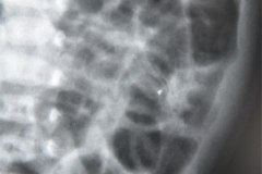 ecn-iia-bell-kliegman-walsh-enterocolitis-necrotizante-o-necrosante-distension-abd-neumatosis-2000-004