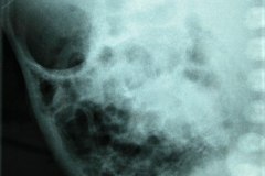 ecn-iia-bell-kliegman-walsh-enterocolitis-necrotizante-o-necrosante-edema-asas-carrilera-2005-003