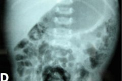 ecn-iia-bell-kliegman-walsh-enterocolitis-necrotizante-o-necrosante-edema-asas-carrilera-2005-004