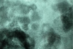 ecn-iia-bell-kliegman-walsh-enterocolitis-necrotizante-o-necrosante-edema-asas-carrilera-2005-005