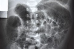 ecn-iia-bell-kliegman-walsh-enterocolitis-necrotizante-o-necrosante-edema-asas-neumatosis-1987-000
