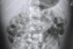ecn-iia-bell-kliegman-walsh-enterocolitis-necrotizante-o-necrosante-edema-asas-neumatosis-1987-001