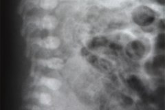 ecn-iia-bell-kliegman-walsh-enterocolitis-necrotizante-o-necrosante-edema-asas-neumatosis-1987-002