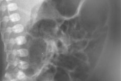 ecn-iia-bell-kliegman-walsh-enterocolitis-necrotizante-o-necrosante-edema-asas-neumatosis-1987-003