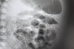 ecn-iia-bell-kliegman-walsh-enterocolitis-necrotizante-o-necrosante-edema-asas-neumatosis-1987-004
