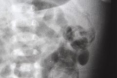 ecn-iia-bell-kliegman-walsh-enterocolitis-necrotizante-o-necrosante-edema-asas-neumatosis-1987-005