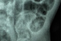 ecn-iia-bell-kliegman-walsh-enterocolitis-necrotizante-o-necrosante-gas-intramural-cateteres-femorales-2005-000