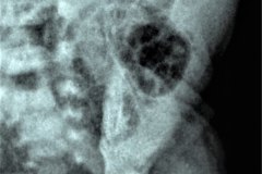 ecn-iia-bell-kliegman-walsh-enterocolitis-necrotizante-o-necrosante-gas-intramural-cateteres-femorales-2005-001