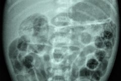 ecn-iia-bell-kliegman-walsh-enterocolitis-necrotizante-o-necrosante-gas-intramural-cateteres-femorales-2005-002