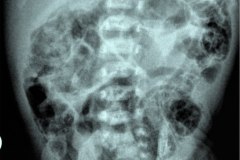 ecn-iia-bell-kliegman-walsh-enterocolitis-necrotizante-o-necrosante-gas-intramural-cateteres-femorales-2005-003