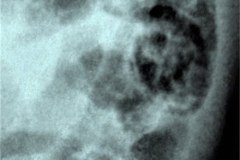 ecn-iia-bell-kliegman-walsh-enterocolitis-necrotizante-o-necrosante-gas-intramural-cateteres-femorales-2005-004