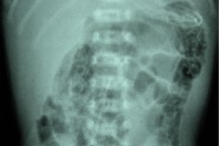 ecn-iia-bell-kliegman-walsh-enterocolitis-necrotizante-o-necrosante-gas-intramural-cateteres-femorales-2005-005