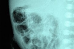 ecn-iia-bell-kliegman-walsh-enterocolitis-necrotizante-o-necrosante-gas-intramural-cateteres-femorales-2005-006