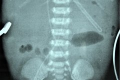ecn-iia-bell-kliegman-walsh-enterocolitis-necrotizante-o-necrosante-gas-intramural-cateteres-femorales-2005-007