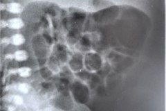 ecn-iia-bell-kliegman-walsh-enterocolitis-necrotizante-o-necrosante-neumatosis-1998-002