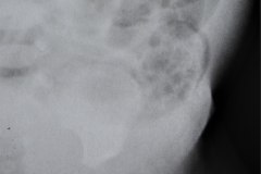 ecn-iia-bell-kliegman-walsh-enterocolitis-necrotizante-o-necrosante-neumatosis-2000-000