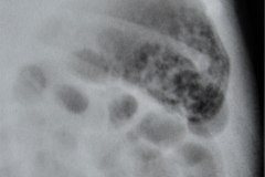 ecn-iia-bell-kliegman-walsh-enterocolitis-necrotizante-o-necrosante-neumatosis-2000-001