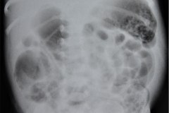 ecn-iia-bell-kliegman-walsh-enterocolitis-necrotizante-o-necrosante-neumatosis-2000-002