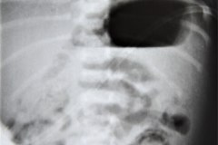 ecn-iia-bell-kliegman-walsh-enterocolitis-necrotizante-o-necrosante-neumatosis-nivel-hidroaereo-gastrico-1987-000