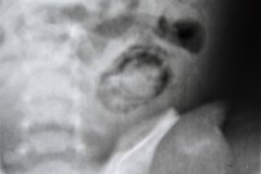 ecn-iia-bell-kliegman-walsh-enterocolitis-necrotizante-o-necrosante-neumatosis-nivel-hidroaereo-gastrico-1987-001