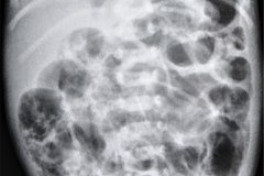 ecn-iib-bell-kliegman-walsh-enterocolitis-necrotizante-o-necrosante-neumatosis-portograma-2005-004