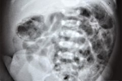 ecn-iib-bell-kliegman-walsh-enterocolitis-necrotizante-o-necrosante-portograma-y-artefactos-del-chasis-simulandolo-cateter-venoso-der-1991-004