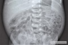 ecn-iib-bell-kliegman-walsh-enterocolitis-necrotizante-o-necrosante-portograma-y-artefactos-del-chasis-simulandolo-cateter-venoso-der-1991-006