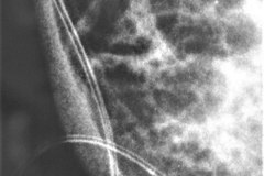ecn-iiib-bell-kliegman-walsh-enterocolitis-necrotizante-o-necrosante-neumoperitoneo-2004-000