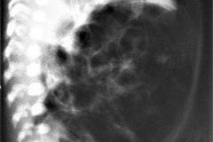 ecn-iiib-bell-kliegman-walsh-enterocolitis-necrotizante-o-necrosante-neumoperitoneo-neumatosis-1998-002