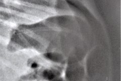 ecn-iiib-bell-kliegman-walsh-enterocolitis-necrotizante-o-necrosante-perforacion-intest-neumoperitoneo-1986-001