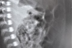 ecn-iiib-bell-kliegman-walsh-enterocolitis-necrotizante-o-necrosante-perforacion-intest-neumoperitoneo-1986-003