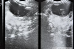 ecografia-abdominal-normal-1996-002