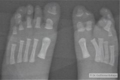 ectrodactilia-ectodermica-displasia-hendido-cleft-labiopalatina-eec-1983-003
