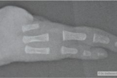 ectrodactilia-ectodermica-displasia-hendido-cleft-labiopalatina-eec-1989-001
