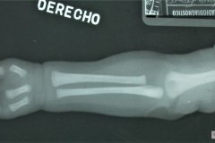 ectrodactilia-mano-bil-1988-001